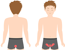 脱毛部位の図　-VIOライン-